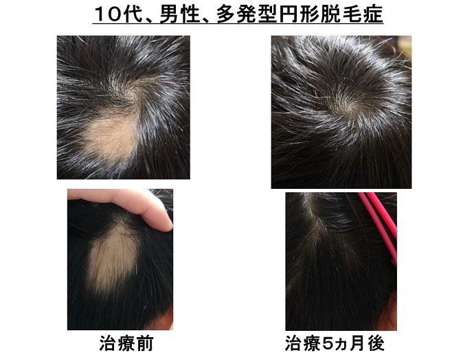 円形脱毛症　病院